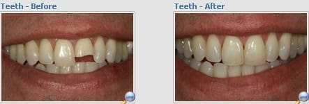 7344132592 6cbf2937cd o - Dental Procedures That Can Brighten Your Smile