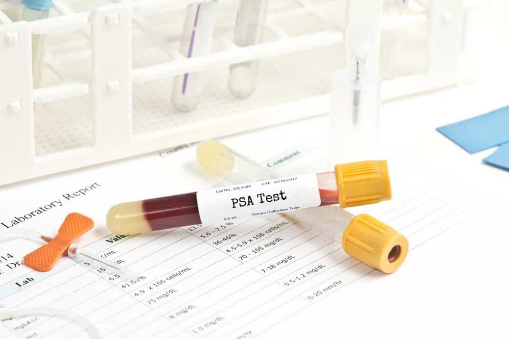 PSA test - Different Types of Treatment For Prostate Cancer