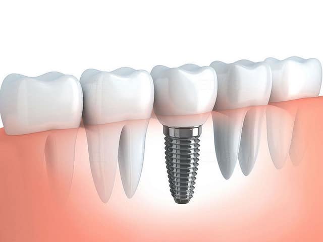 34279126436 16a293e74d z - What Do Dental Implants Do?
