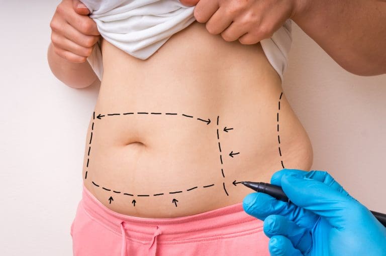 A Short Guide for Tummy Tuck/Liposuction in Mexico - The Aspiring Gentleman