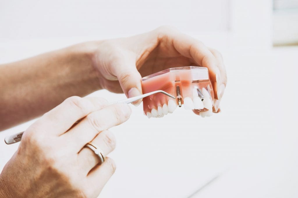 Benefits of Choosing Dental Implants