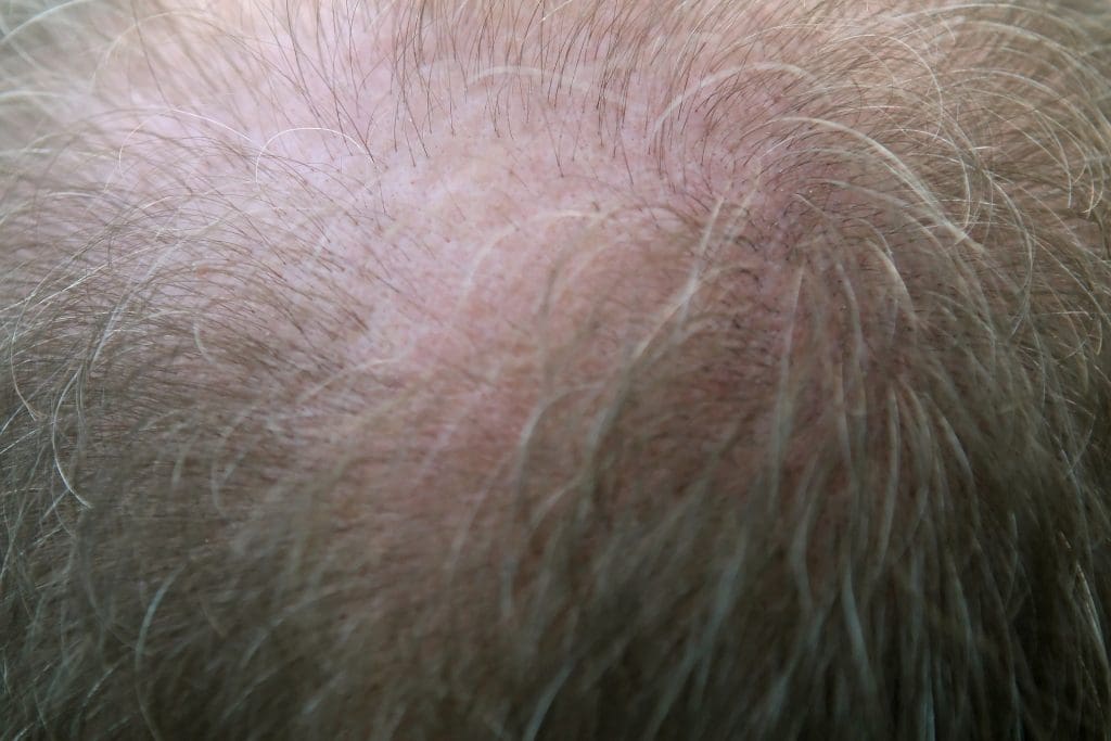 Hair Loss What You Need To Know 1024x683 - DHT And Hair Loss What You Need To Know