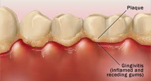 Dental Plaque 1 - What Is Gum Disease and What Is A Periodontist Role?