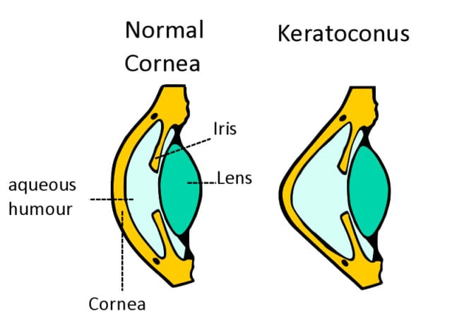 Eye Doctors Reveal Facts About Keratoconus