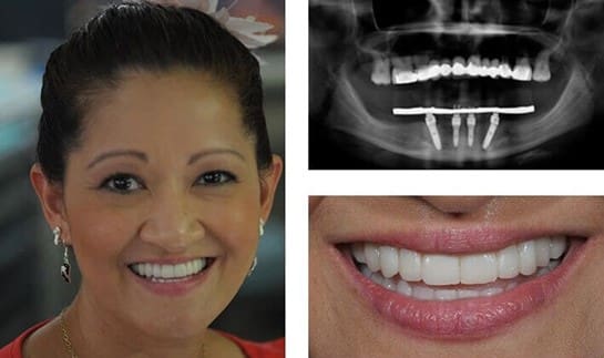 Who Is the Perfect Candidate for All On 4 Dental Implants?