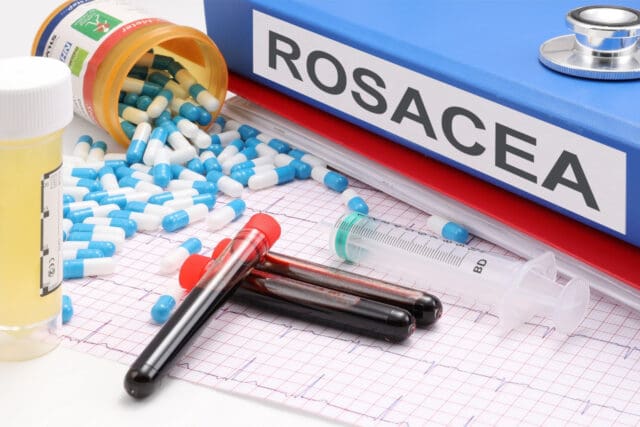 What To Avoid When Treating Rosacea