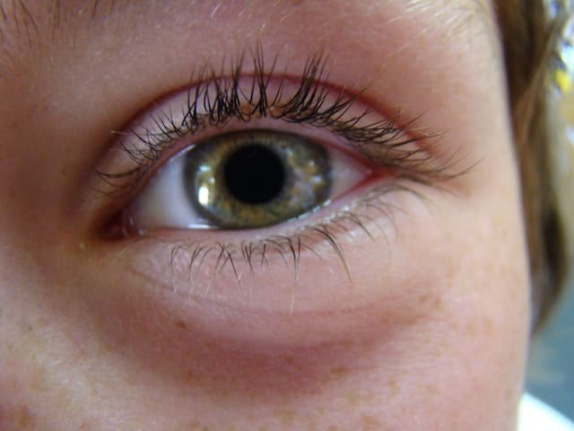 Eye Puffiness Eye Puffiness