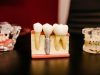 The Cost of Full Mouth Dental Implants: Is It Worth the Investment? Full Mouth Dental Implants