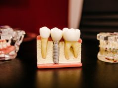 The Cost of Full Mouth Dental Implants: Is It Worth the Investment? Full Mouth Dental Implants